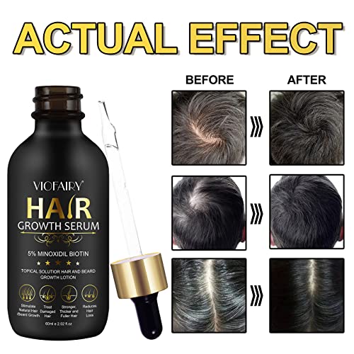 5% Minoxidil for Men and Women Hair Growth Oil  Biotin Serum  Hair Regrowth Treatment for Scalp Hair Loss  Natural  for Thicker Longer Fuller Healthier Hair 2.02 oz